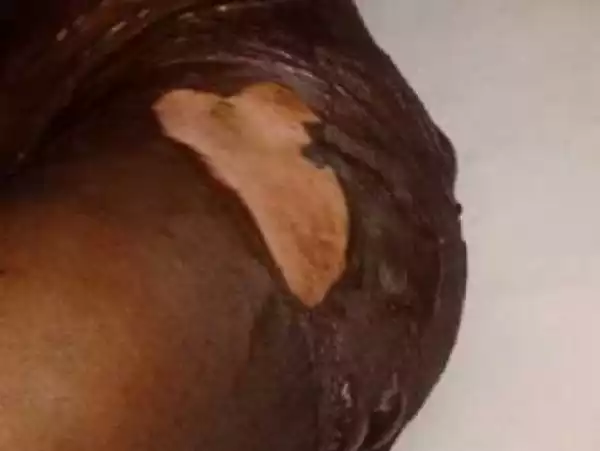Evil World: Mother Pours Very Hot Palm Oil on Her Only Daughter (Graphic Photo)